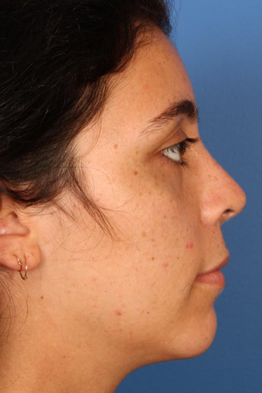 Rhinoplasty Before & After Photo