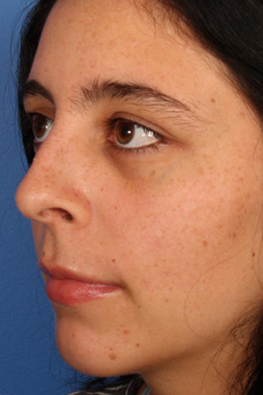 Rhinoplasty Before & After Photo