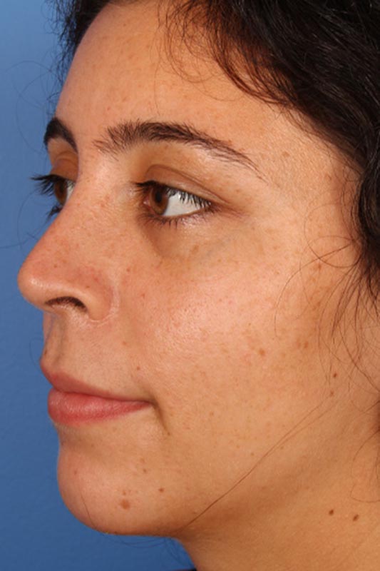 Rhinoplasty Before & After Photo