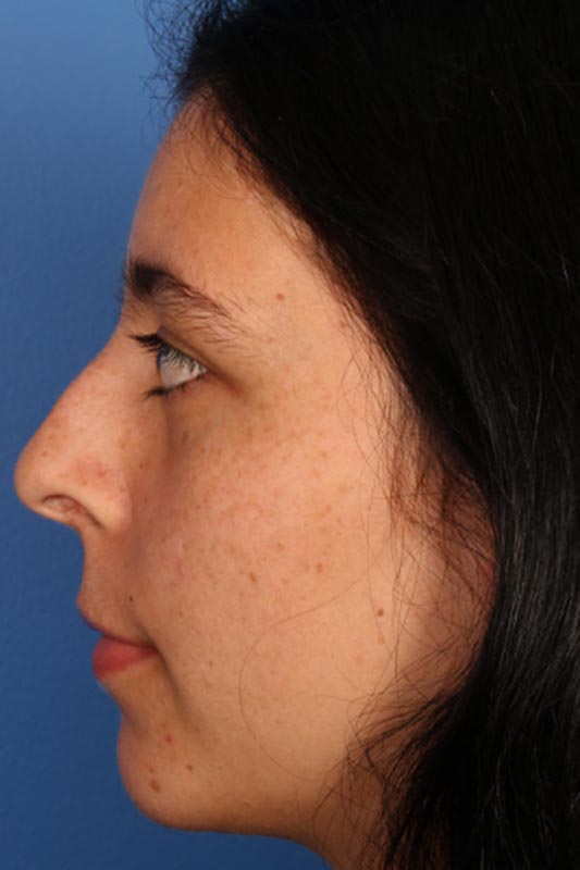 Rhinoplasty Before & After Photo