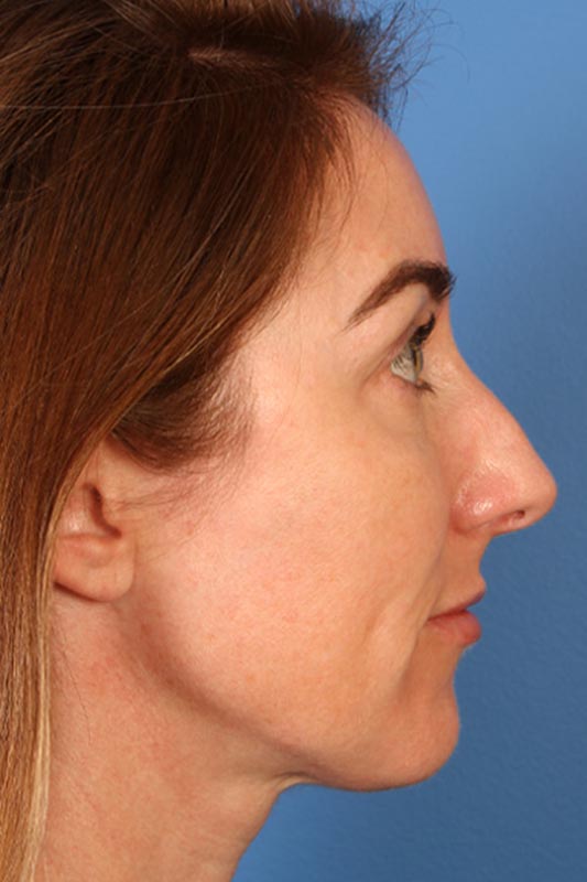 Rhinoplasty Before & After Photo