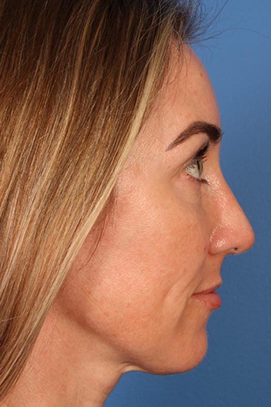 Rhinoplasty Before & After Photo