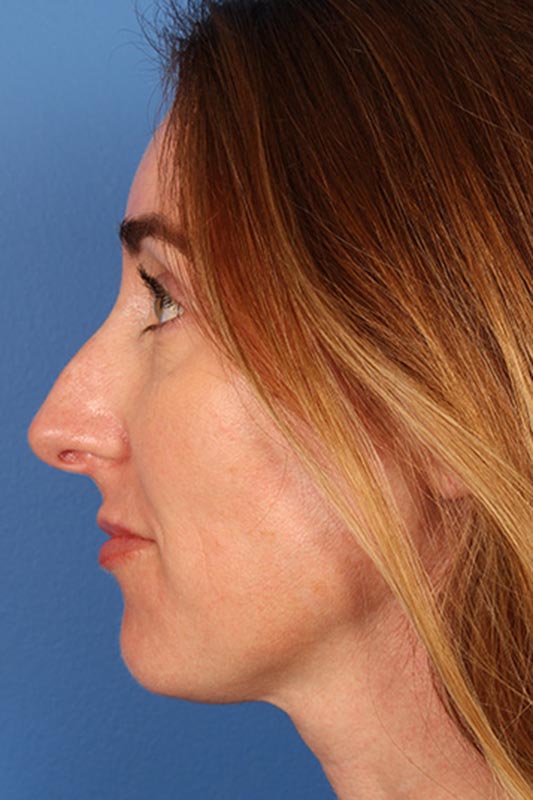 Rhinoplasty Before & After Photo