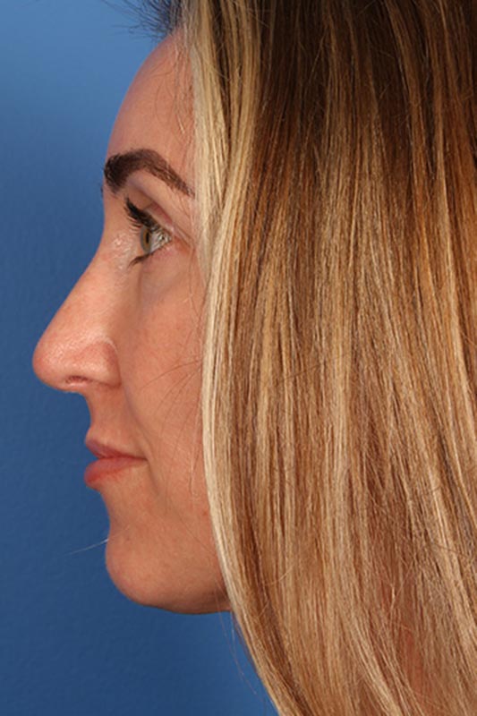 Rhinoplasty Before & After Photo