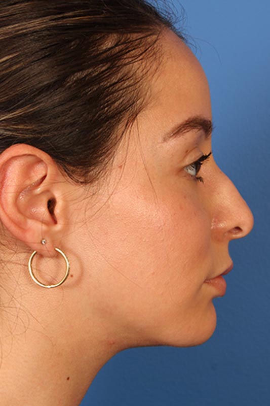 Rhinoplasty Before & After Photo