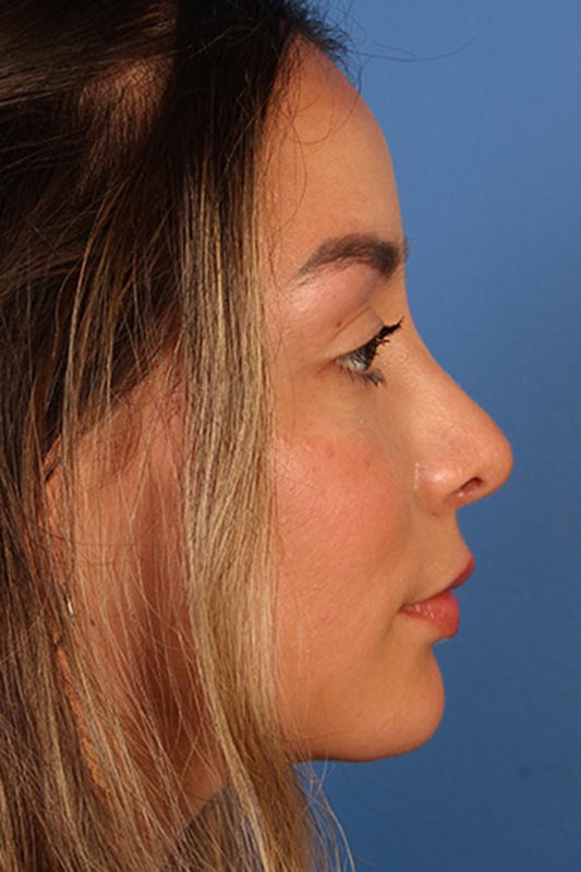 Rhinoplasty Before & After Photo