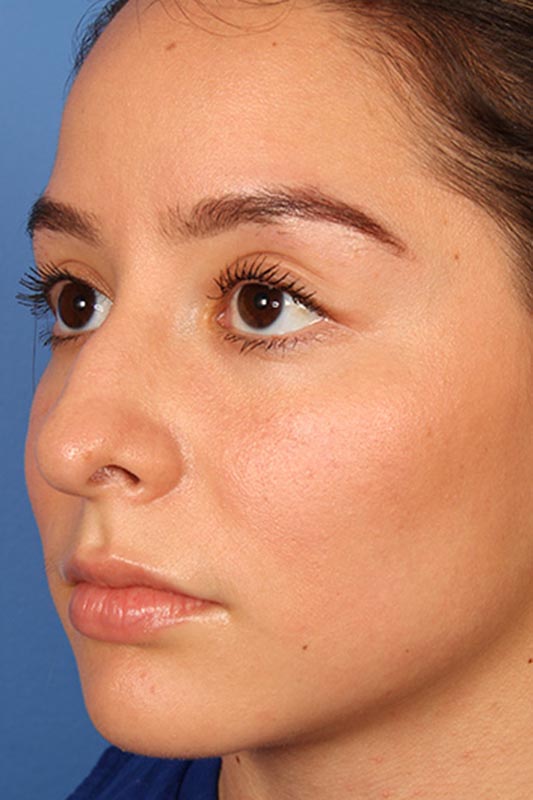 Rhinoplasty Before & After Photo