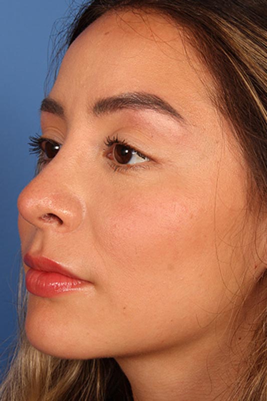 Rhinoplasty Before & After Photo