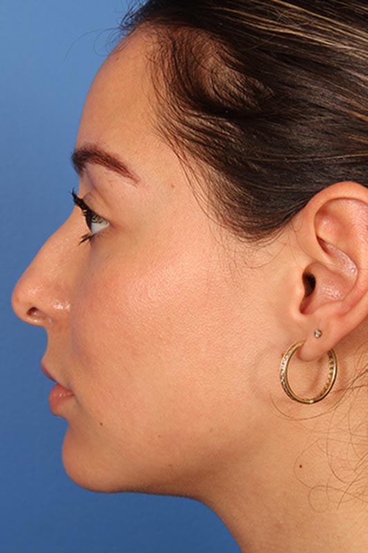 Rhinoplasty Before & After Photo