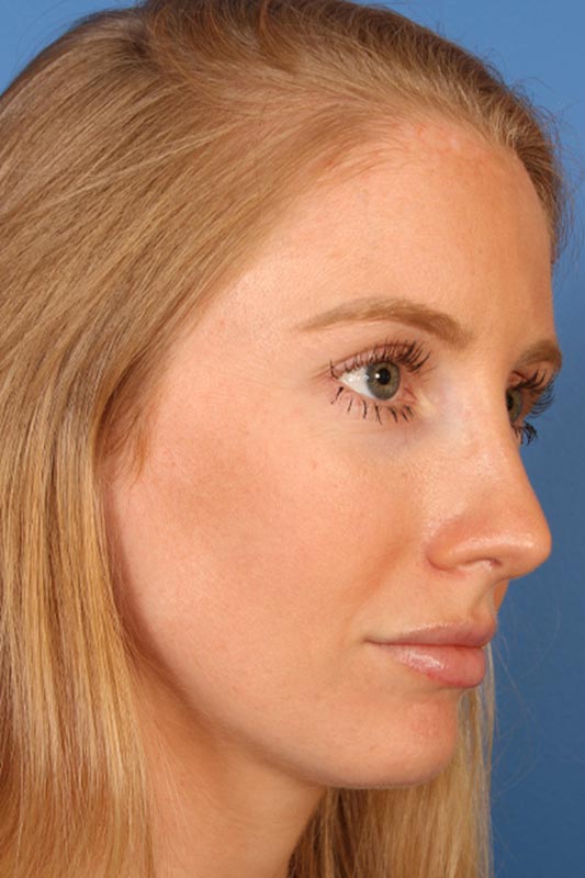 Rhinoplasty Before & After Photo