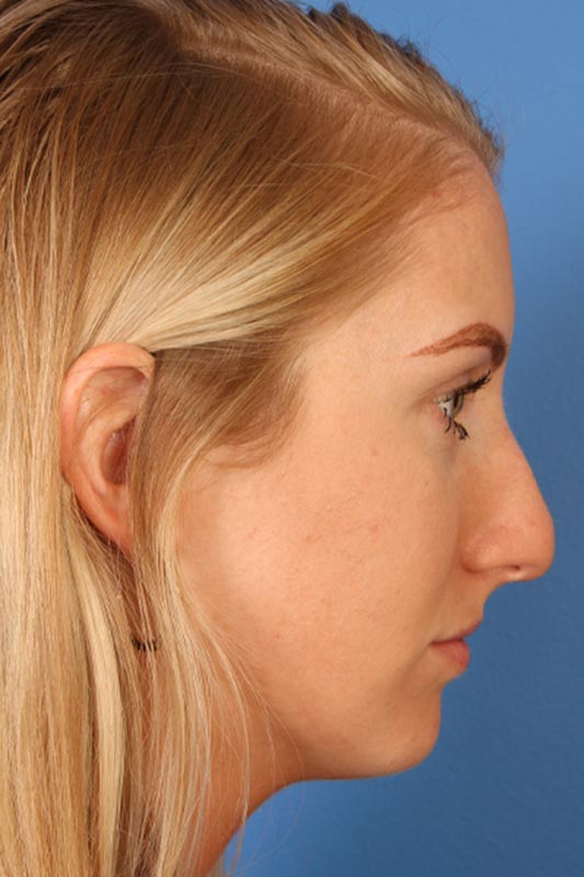 Rhinoplasty Before & After Photo