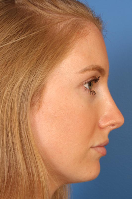 Rhinoplasty Before & After Photo