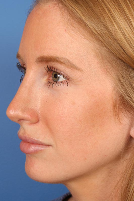 Rhinoplasty Before & After Photo