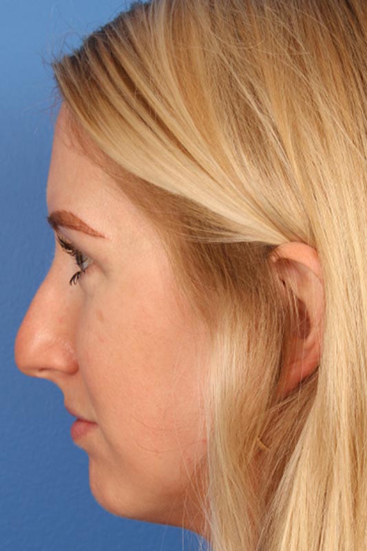 Rhinoplasty Before & After Photo