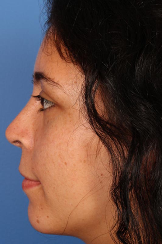 Rhinoplasty Before & After Photo