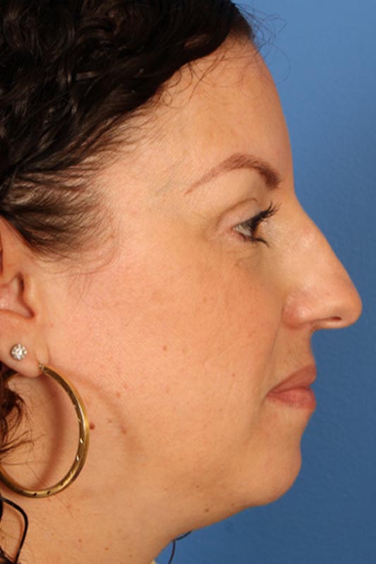 Rhinoplasty Before & After Photo