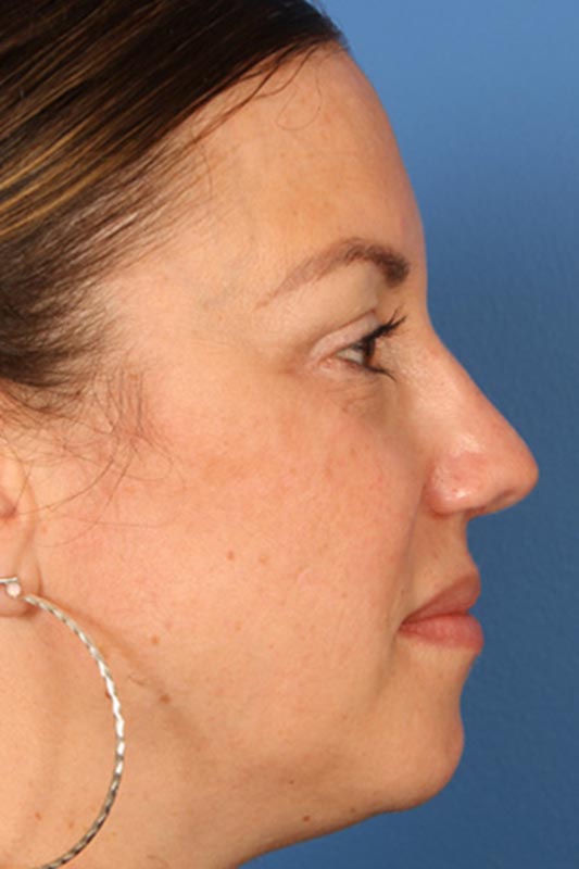 Rhinoplasty Before & After Photo