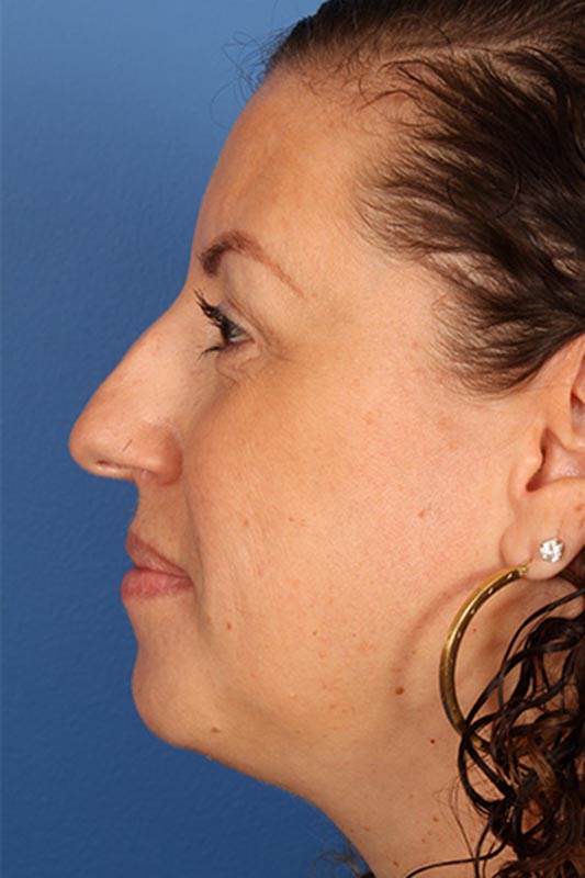 Rhinoplasty Before & After Photo