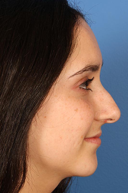 Rhinoplasty Before & After Photo