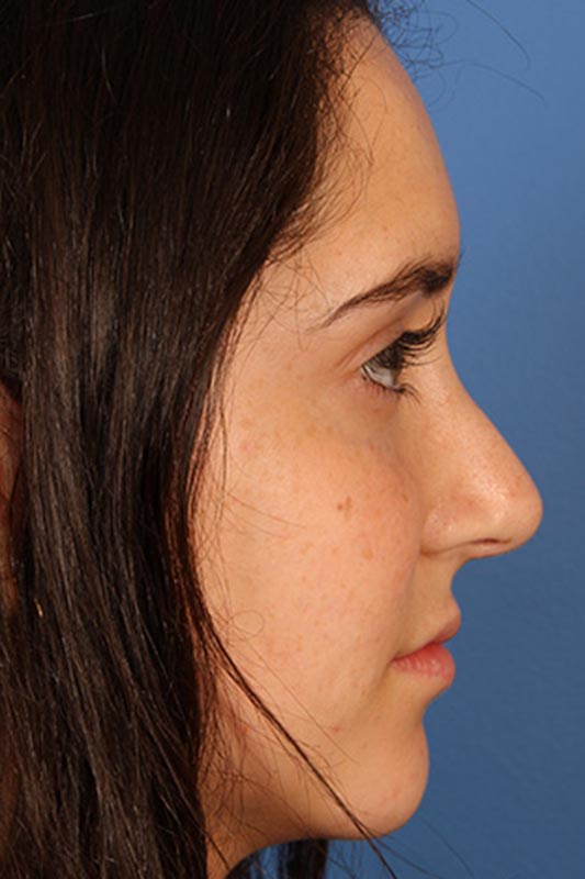 Rhinoplasty Before & After Photo