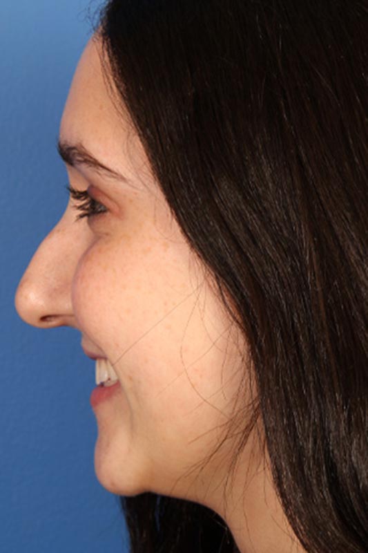 Rhinoplasty Before & After Photo