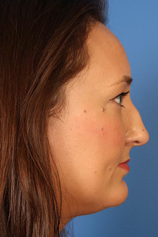 Rhinoplasty Before & After Photo