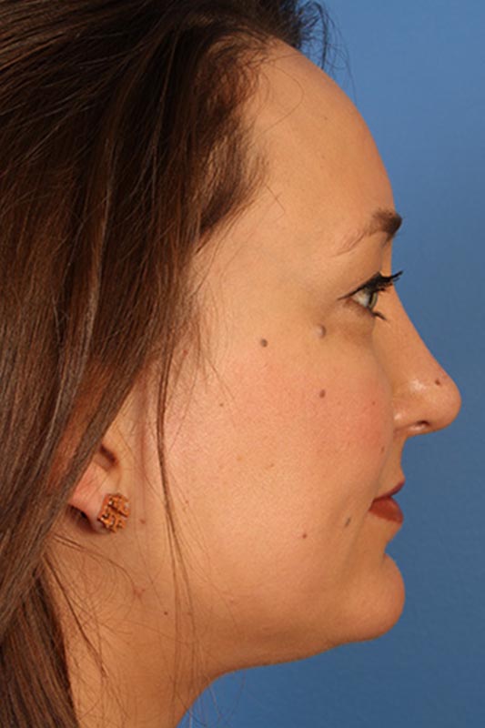 Rhinoplasty Before & After Photo