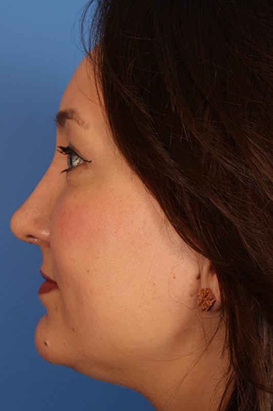 Rhinoplasty Before & After Photo