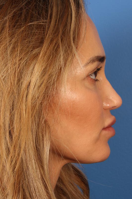 Rhinoplasty Before & After Photo