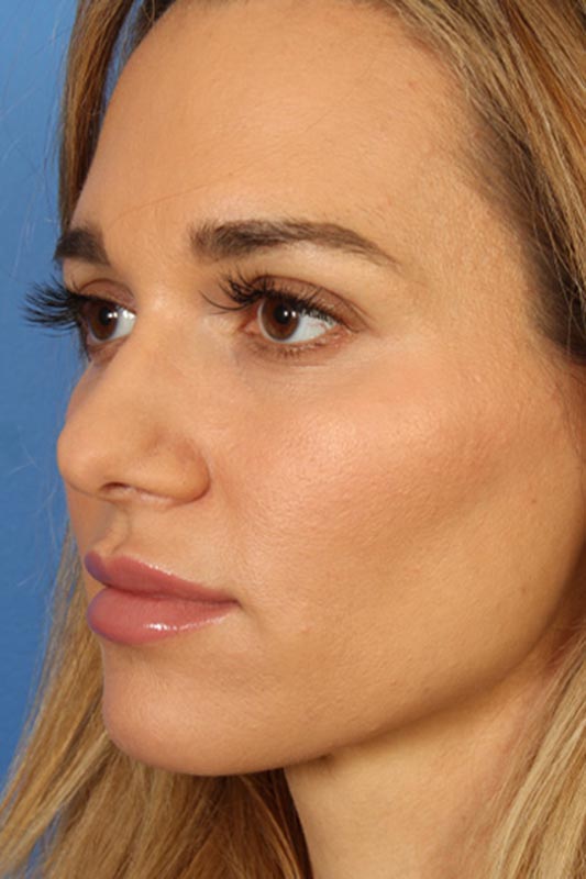 Rhinoplasty Before & After Photo