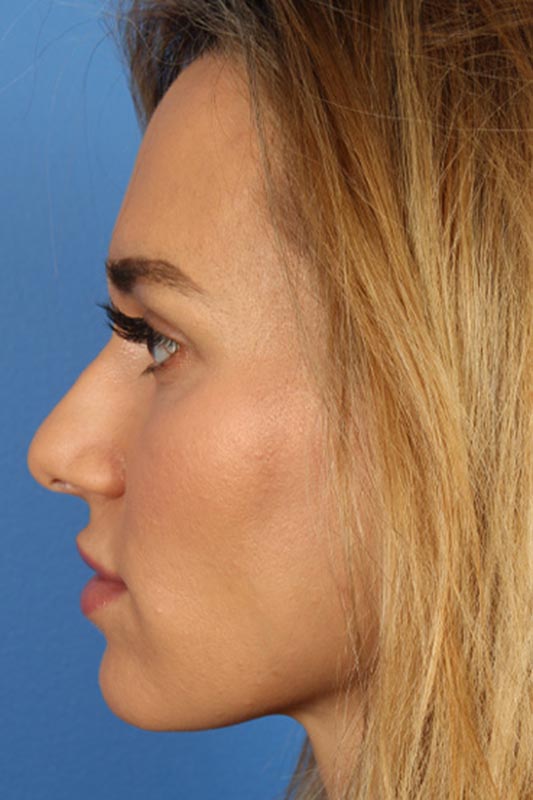 Rhinoplasty Before & After Photo