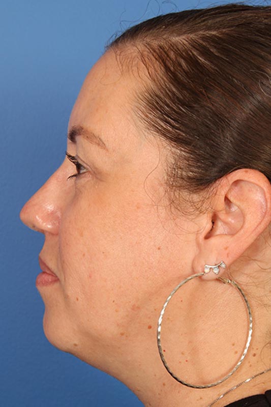 Rhinoplasty Before & After Photo