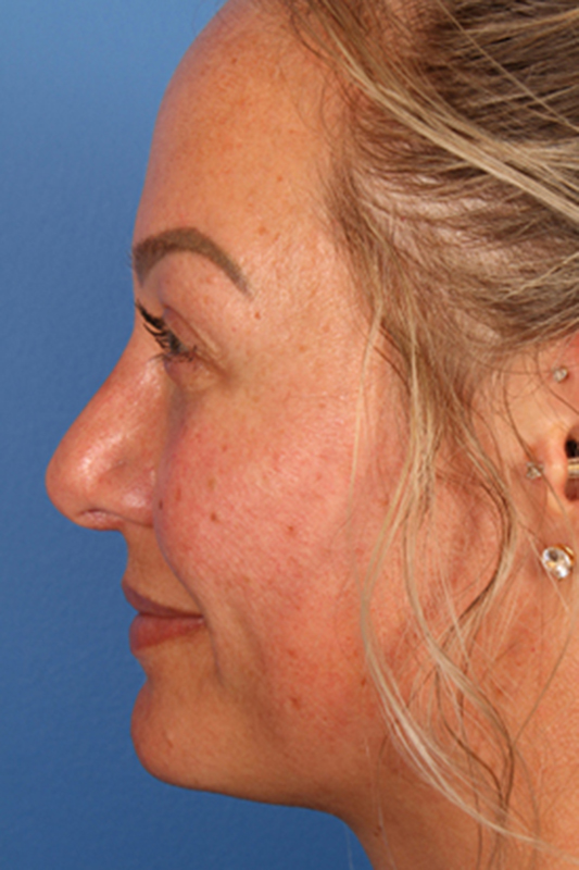 Rhinoplasty Before & After Photo