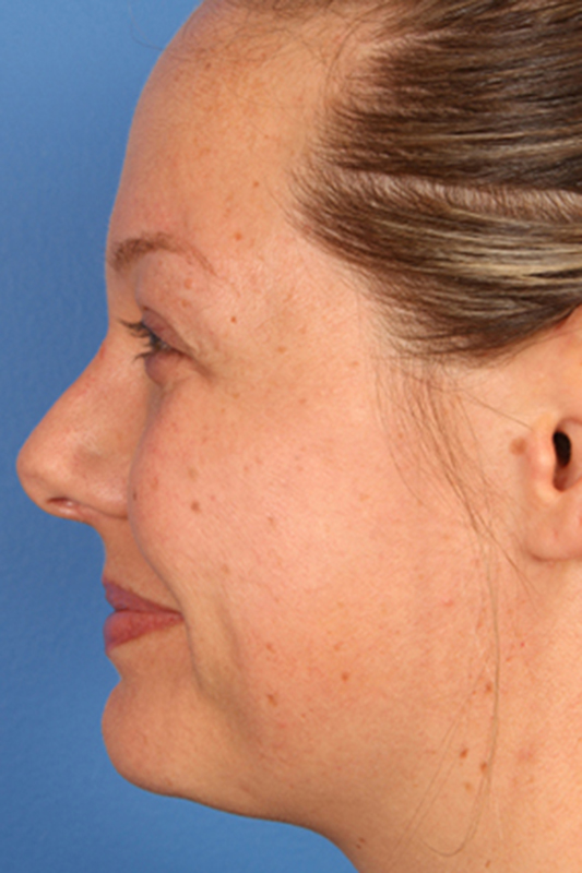 Rhinoplasty Before & After Photo