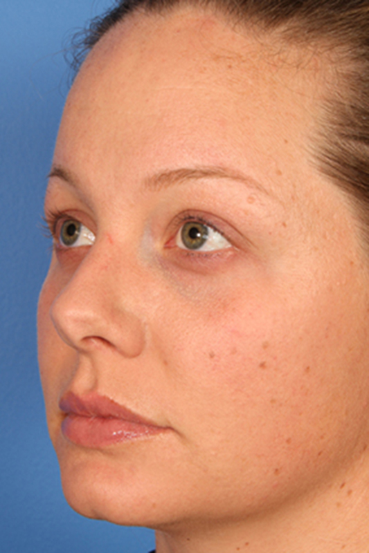 Rhinoplasty Before & After Photo