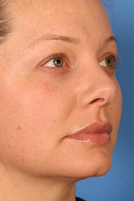 Rhinoplasty Before & After Photo