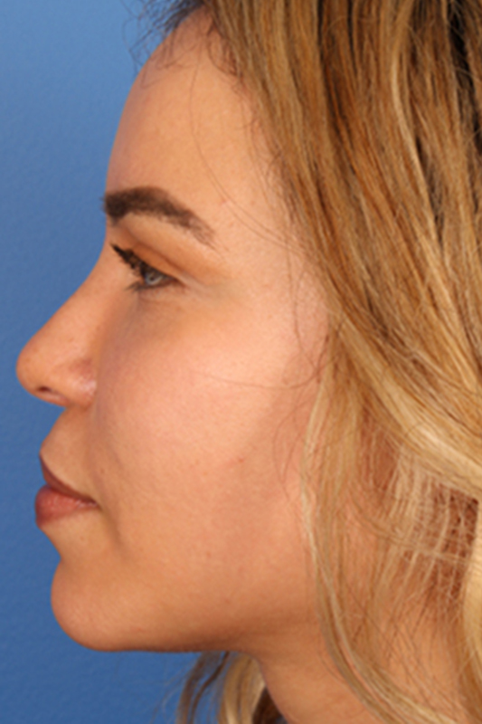 Rhinoplasty Before & After Photo