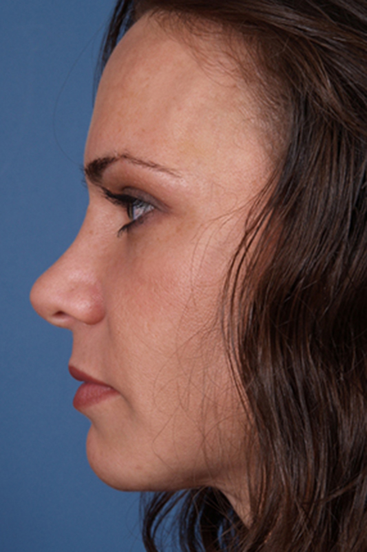 Rhinoplasty Before & After Photo