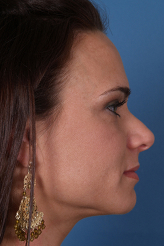 Rhinoplasty Before & After Photo