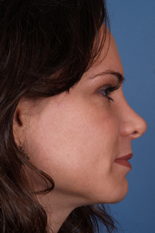 Rhinoplasty Before & After Photo