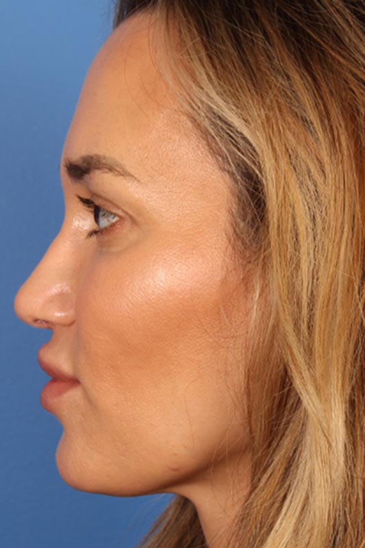 Rhinoplasty Before & After Photo