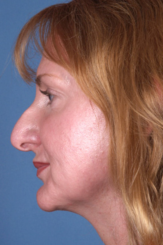 Rhinoplasty Before & After Photo