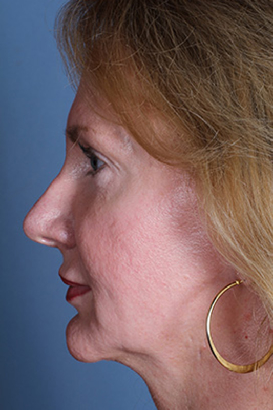 Rhinoplasty Before & After Photo