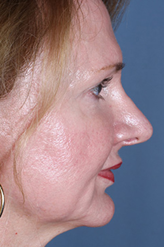 Rhinoplasty Before & After Photo