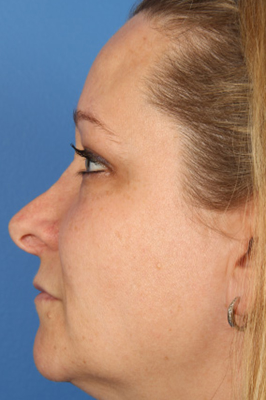 Rhinoplasty Before & After Photo