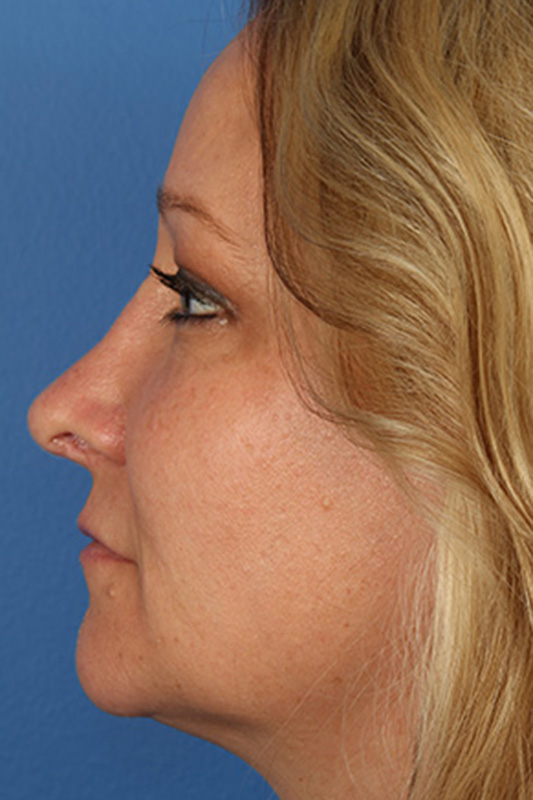 Rhinoplasty Before & After Photo