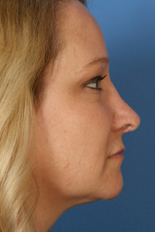 Rhinoplasty Before & After Photo