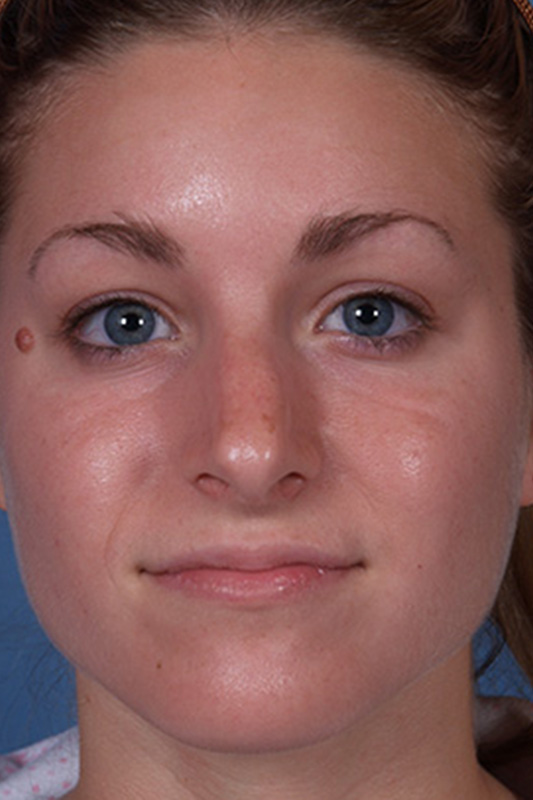 Rhinoplasty Before & After Photo