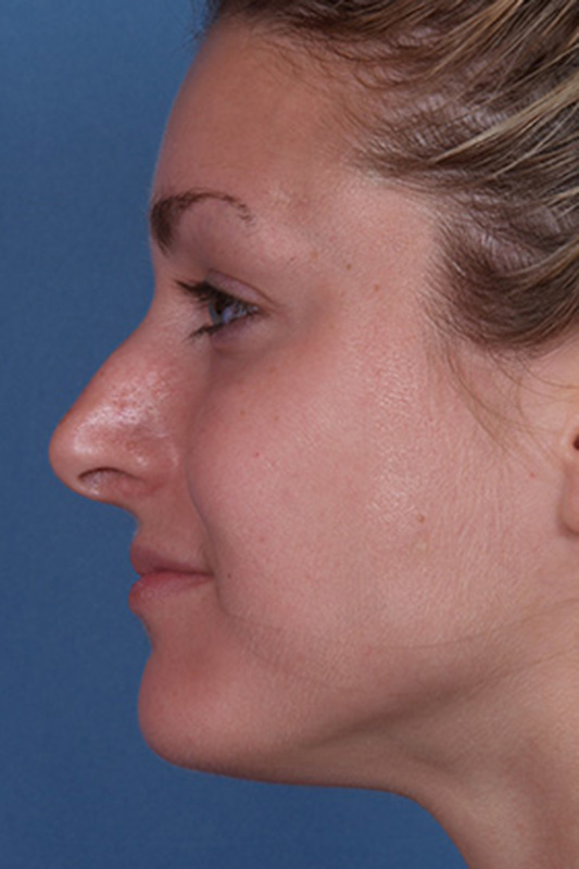 Rhinoplasty Before & After Photo