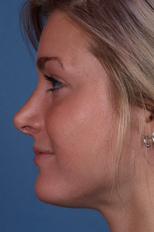 Rhinoplasty Before & After Photo